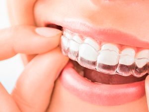 ortodoncia-invisible-photo