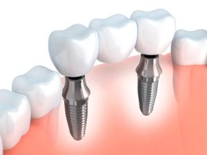 implantes dentales-2