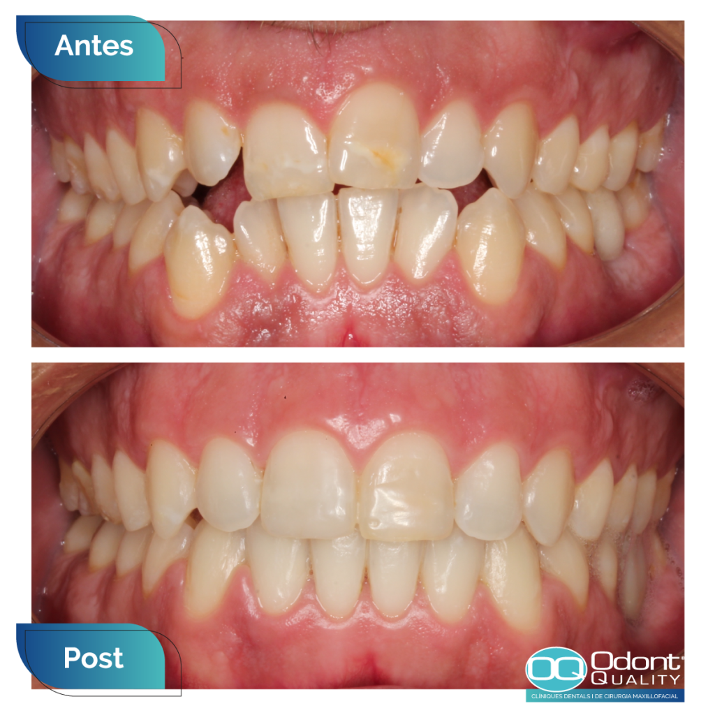 caso-real-ortodoncia-6