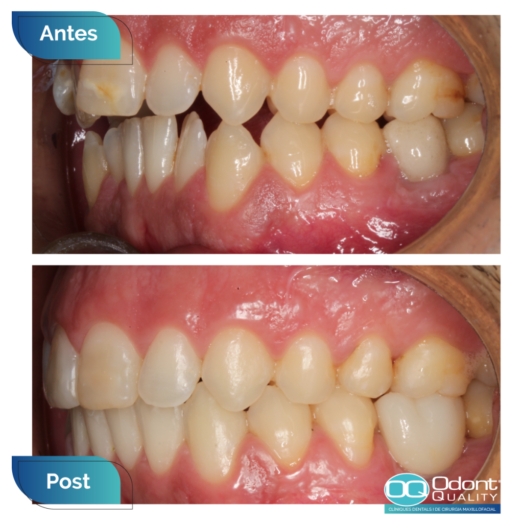 caso-real-ortodoncia-5