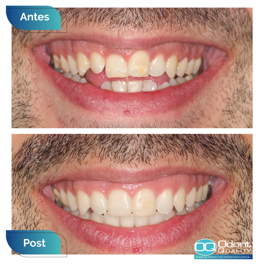 caso-real-ortodoncia-4