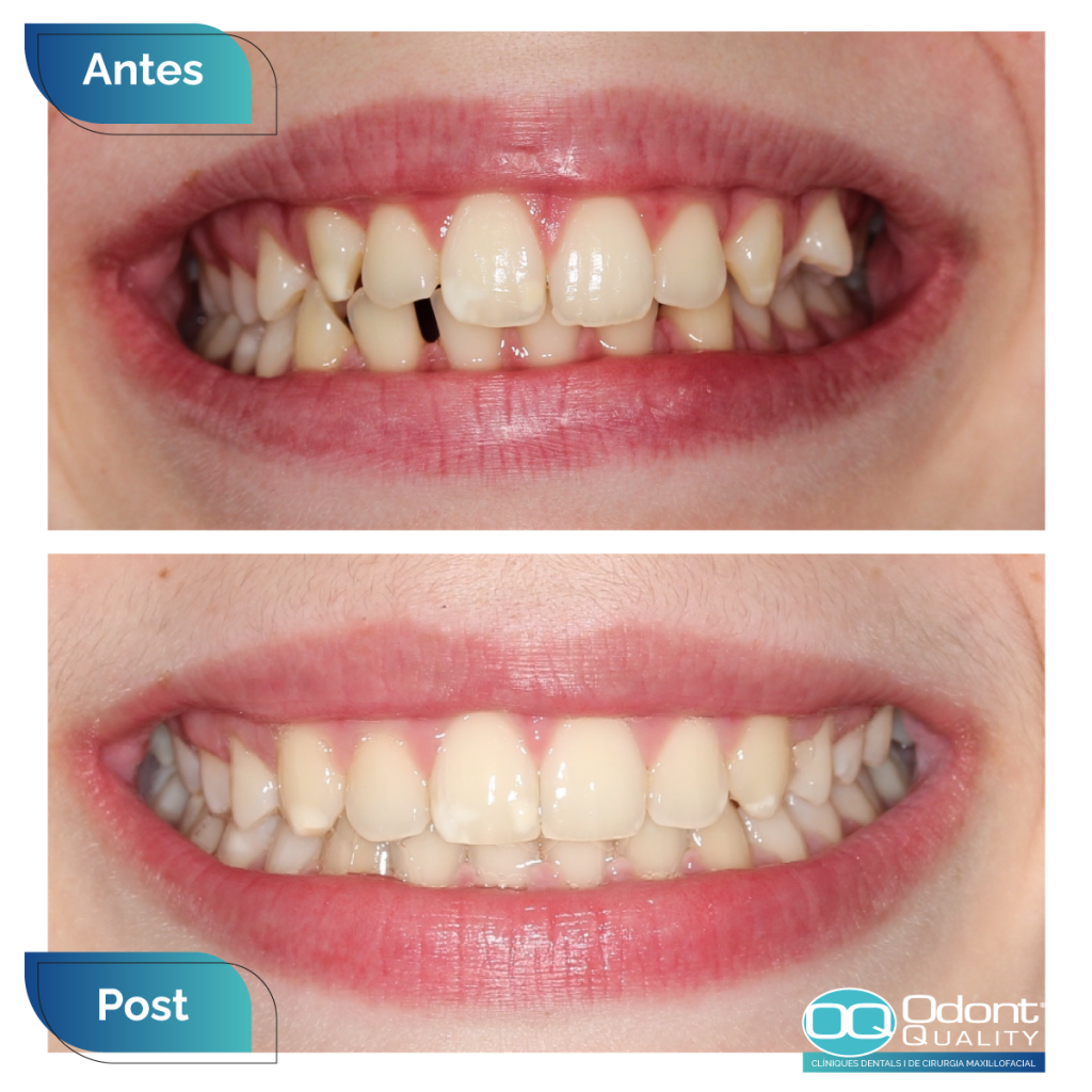 caso-real-ortodoncia-3