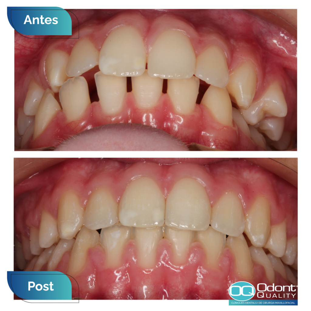 caso-real-ortodoncia-2