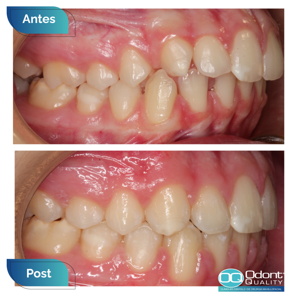 caso-real-ortodoncia-1